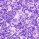 Study Suggests Higher CD4 Counts Reduce Risk Of HIV-Induced Cancer