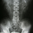 Vertebroplasty Relieves Pain For Multiple Myeloma Patients With Spinal Fractures