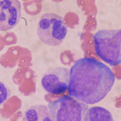 Anti-Thymocyte Globulin Prior To Transplantation May Improve Prognosis Of MDS Patients (ASCO 2012)