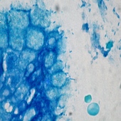 Eradicating H. pylori Infection Not Linked To MGUS Regression