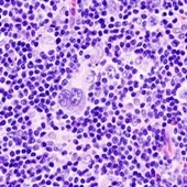 Study Suggests Higher CD4 Counts Reduce Risk Of HIV-Induced Cancer