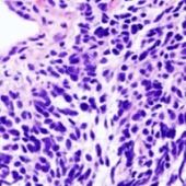 Study Finds That Certain Cancers Are More Common In HIV-Infected Individuals