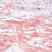 Multiple Myeloma-Associated Amyloidosis – What Every Patient Should Know