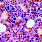 Relapse In MDS Patients After Partially-Matched Donor Stem Cell Transplantation Frequently Occurs Outside The Bone Marrow
