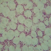 Stem Cell Transplants May Improve Kidney Function of Myeloma Patients