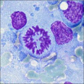 Multiple Myeloma Molecular Subtypes Are Already Present In MGUS And Smoldering Myeloma Patients