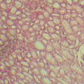 Kidney Failure In Multiple Myeloma Patients – Part 2: Treatment