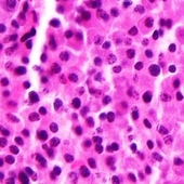 Sequence Of Velcade And Revlimid Treatment May Not Matter In Many Multiple Myeloma Patients (ASH 2011)