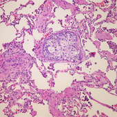 Extramedullary Myeloma