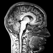 Common Link Found Between HIV-Related Memory Loss And Alzheimer’s Disease