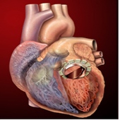 Side Effects Of Antiretroviral Treatment: HIV And Heart Disease (AIDS 2010)