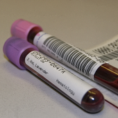 Serum Albumin Levels Indicate Severity Of Multiple Myeloma