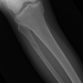 Revlimid-Dexamethasone Has Mixed Effects On Bone Disease In Relapsed/Refractory Multiple Myeloma