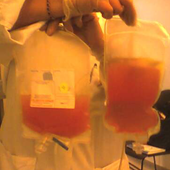 Skipped Bone Marrow Exams Give False Positives In Multiple Myeloma Clinical Trials
