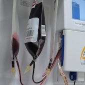Combination Of Vidaza And Donor Lymphocyte Infusions Shows Promise In Relapsed MDS Patients (ASH 2011)