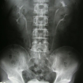 Study Finds That Vitamin D Deficiencies May Contribute To High Parathyroid Hormone Levels And Bone Loss In HIV Patients Taking Viread Or Truvada