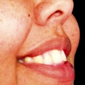 Investigational Gel May Be Safe And Effective For Facial Fat Loss In People With HIV
