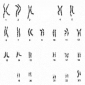 Clinical Response To Vidaza May Not Depend On Chromosomal Response In MDS Patients