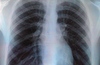 Solitary Bone Plasmacytoma – What Every Patient Should Know