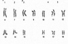 Researchers Develop New MDS Classification System Based On Chromosomal Abnormalities